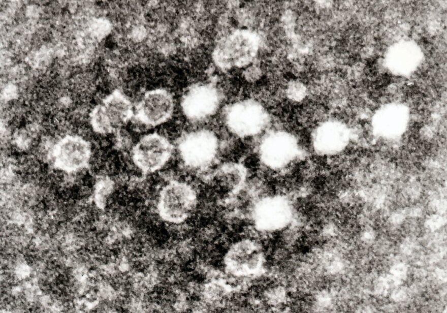 Electron micrograph of negatively stained Parvovirus B19 in blood. Each virus particle is about 25 to 30nM in diameter. Graham Beards at English Wikipedia, CC BY 3.0 <https://creativecommons.org/licenses/by/3.0>, via Wikimedia Commons