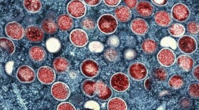 FILE - This undated image provided by the National Institute of Allergy and Infectious Diseases shows a colorized transmission electron micrograph of mpox particles (red) found within an infected cell (blue), cultured in the laboratory that was captured and color-enhanced at the NIAID Integrated Research Facility in Fort Detrick, Md. (NIAID via AP, File)